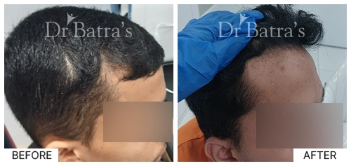 Hair Falling Treatment